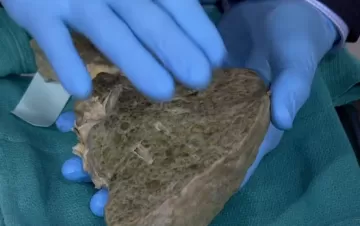 Как выглядит настоящая печень больного циррозом