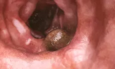 Онкологи перечислили ранние симптомы колоректального рака