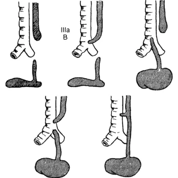 Атрезия пищевода