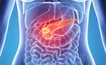 Хронический панкреатит