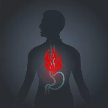 Рефлюкс-эзофагит