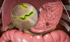 Инфекция Helicobacter pylori эволюционирует вместе с человеком
