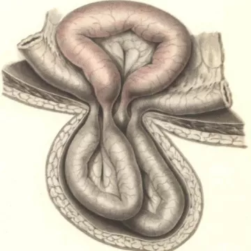 Ущемление грыжи