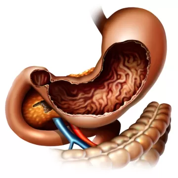 Пилороспазм