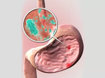 Гастроэнтеролог Лопатина: Язва желудка не связана с питанием