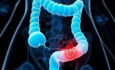 Врач развеяла популярные мифы о раке кишечника