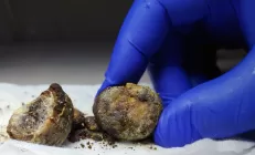 Камни в желчном пузыре. Нужно ли удалять орган?