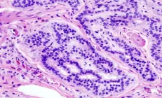 Гастроэнтеролог назвал первый сигнал рака кишечника