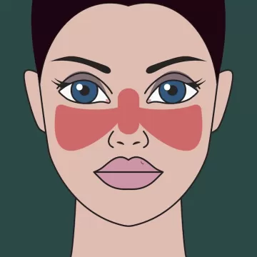 Системная красная волчанка