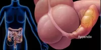 Абсцесс аппендикулярный