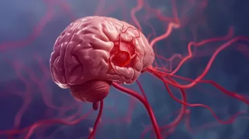 Учёные: У людей с ГЭРБ и СРК чаще развивается аневризма головного мозга