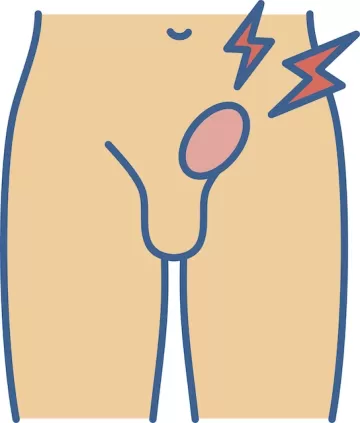 Паховая грыжа