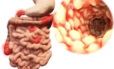 Датские ученые: Почти 30% пациентов с ВЗК страдает поражениями кожи