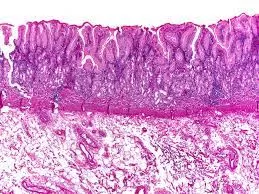Коварство атрофического гастрита: что делать, если у вас обнаружили «тихий предрак»?