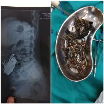 Инородное тело в желудке