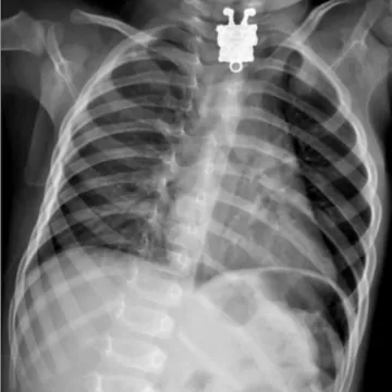 Инородное тело пищевода