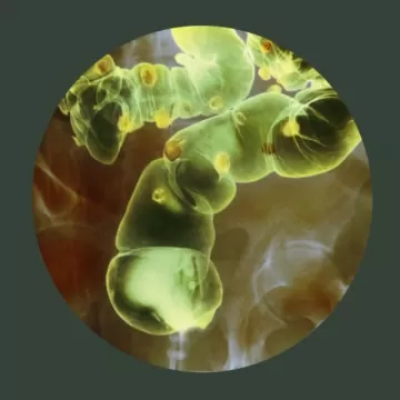 Дивертикулит