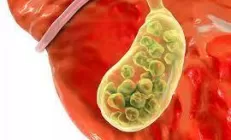 Желчнокаменная болезнь (холелитиаз)