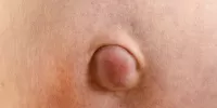 Пупочная грыжа