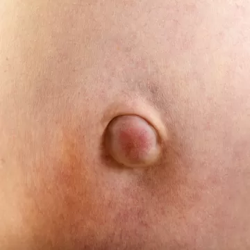 Пупочная грыжа