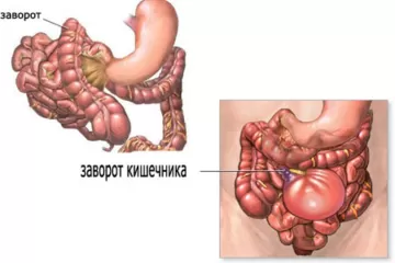 Заворот кишок