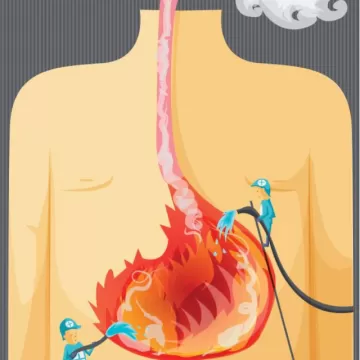 Гастроэзофагеальная рефлюксная болезнь (ГЭРБ)