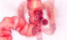 Врачи клиники Мэйо рассказали, кому нужно раннее обследование на рак кишечника