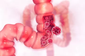 Врачи клиники Мэйо рассказали, кому нужно раннее обследование на рак кишечника