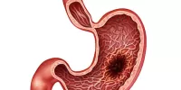 Рак желудка