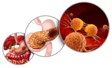 Российские учёные разработали новый подход к лечению панкреатита