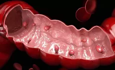 Онколог перечислил признаки полипов в кишечнике