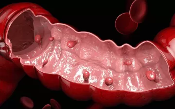 Онколог перечислил признаки полипов в кишечнике