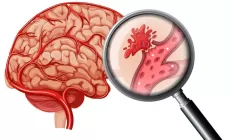Учёные обнаружили связь между воспалительными заболеваниями кишечника и инсультом