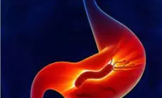 Врач развеяла главные мифы об атрофическом гастрите