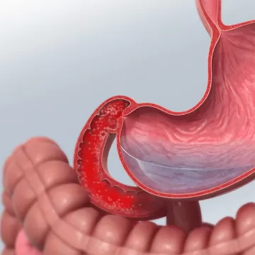 Острый дуоденит