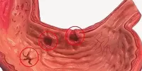Геморрагический гастрит
