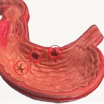 Геморрагический гастрит