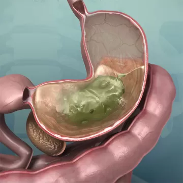 Гастрит атрофический