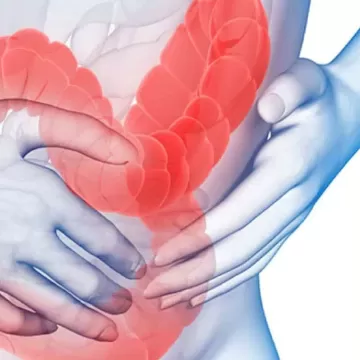 Синдром раздражённого кишечника (СРК)