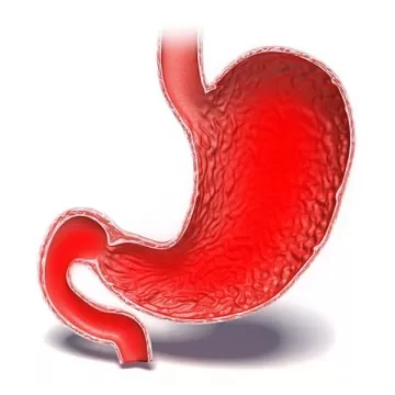Гастродуоденит