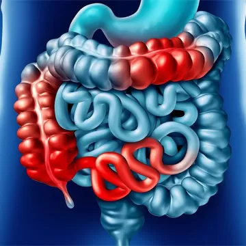 Болезнь Крона