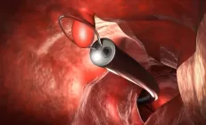 Врач объяснила, какие полипы в ЖКТ нужно срочно удалять, а какие — просто проверять