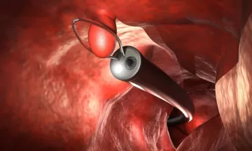 Врач объяснила, какие полипы в ЖКТ нужно срочно удалять, а какие — просто проверять