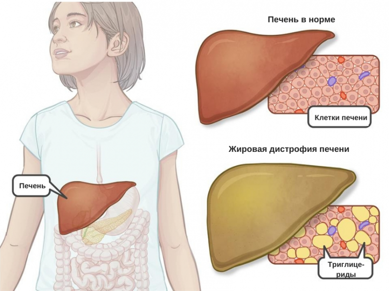 Ожирение печени и лишний