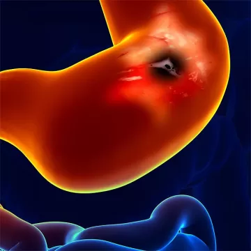 Прободная язва