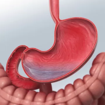 Гастрит и дуоденит