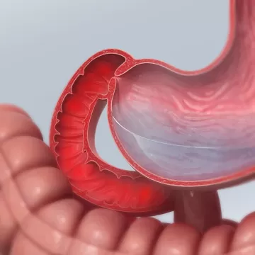 Хронический дуоденит