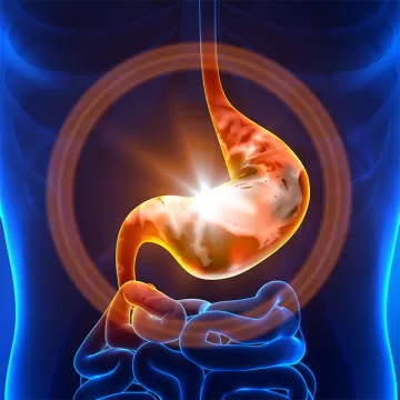 Острый гастрит