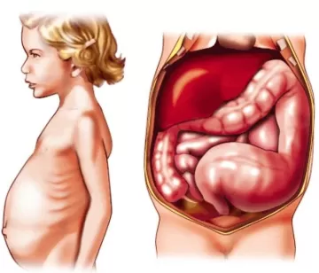 Болезнь Гиршпрунга