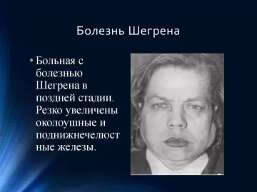 Болезнь Шегрена